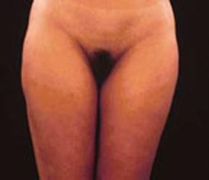 Real patient results before and after plastic surgery results in Glenview, IL, performed by Dr. Casas