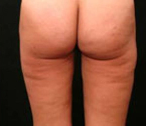 Real patient results before and after plastic surgery results in Glenview, IL, performed by Dr. Casas