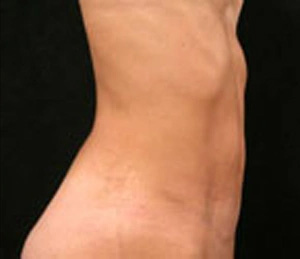 Real patient results before and after plastic surgery results in Glenview, IL, performed by Dr. Casas