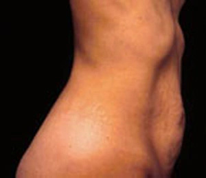 Real patient results before and after plastic surgery results in Glenview, IL, performed by Dr. Casas