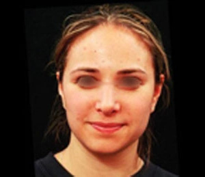 Real patient results before and after plastic surgery results in Glenview, IL, performed by Dr. Casas