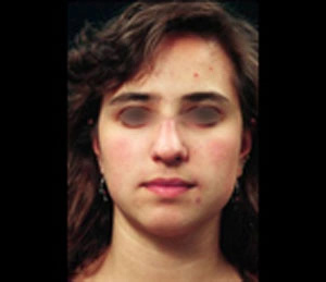 Real patient results before and after plastic surgery results in Glenview, IL, performed by Dr. Casas