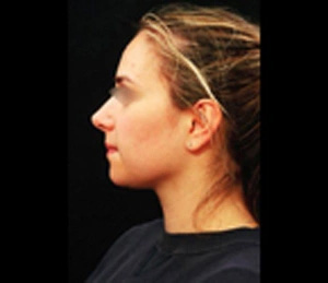 Real patient results before and after plastic surgery results in Glenview, IL, performed by Dr. Casas