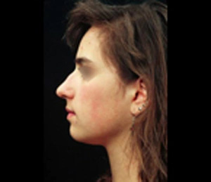 Real patient results before and after plastic surgery results in Glenview, IL, performed by Dr. Casas