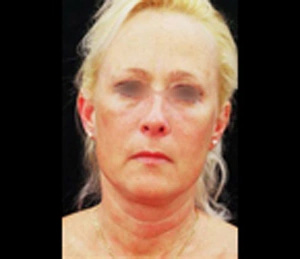 Real patient results before and after plastic surgery results in Glenview, IL, performed by Dr. Casas