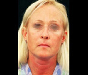 Real patient results before and after plastic surgery results in Glenview, IL, performed by Dr. Casas