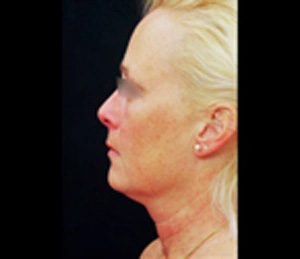 Real patient results before and after plastic surgery results in Glenview, IL, performed by Dr. Casas