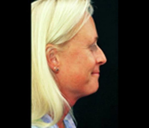 Real patient results before and after plastic surgery results in Glenview, IL, performed by Dr. Casas