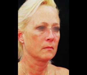 Real patient results before and after plastic surgery results in Glenview, IL, performed by Dr. Casas