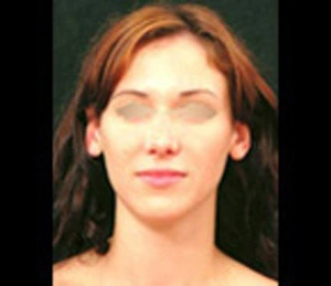 Real patient results before and after plastic surgery results in Glenview, IL, performed by Dr. Casas