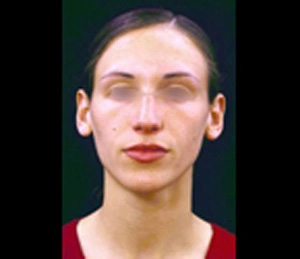 Real patient results before and after plastic surgery results in Glenview, IL, performed by Dr. Casas