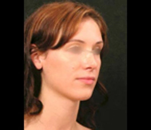 Real patient results before and after plastic surgery results in Glenview, IL, performed by Dr. Casas