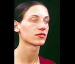 Real patient results before and after plastic surgery results in Glenview, IL, performed by Dr. Casas