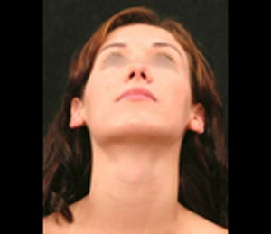 Real patient results before and after plastic surgery results in Glenview, IL, performed by Dr. Casas