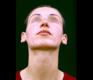 Real patient results before and after plastic surgery results in Glenview, IL, performed by Dr. Casas