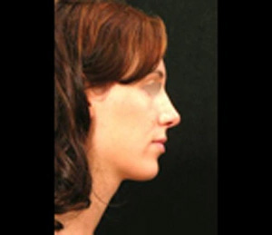 Real patient results before and after plastic surgery results in Glenview, IL, performed by Dr. Casas