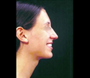Real patient results before and after plastic surgery results in Glenview, IL, performed by Dr. Casas