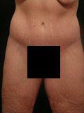 Real patient results before and after plastic surgery results in Glenview, IL, performed by Dr. Casas