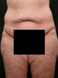 Real patient results before and after plastic surgery results in Glenview, IL, performed by Dr. Casas