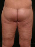 Real patient results before and after plastic surgery results in Glenview, IL, performed by Dr. Casas
