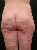 Real patient results before and after plastic surgery results in Glenview, IL, performed by Dr. Casas