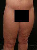 Real patient results before and after plastic surgery results in Glenview, IL, performed by Dr. Casas