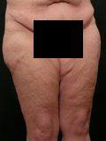 Real patient results before and after plastic surgery results in Glenview, IL, performed by Dr. Casas