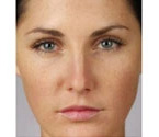 Real patient results before and after plastic surgery results in Glenview, IL, performed by Dr. Casas