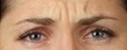 Real patient results before and after plastic surgery results in Glenview, IL, performed by Dr. Casas
