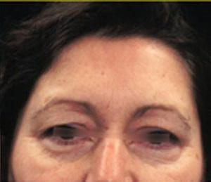 Real patient results before and after plastic surgery results in Glenview, IL, performed by Dr. Casas