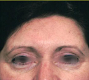 Real patient results before and after plastic surgery results in Glenview, IL, performed by Dr. Casas