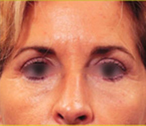 Real patient results before and after plastic surgery results in Glenview, IL, performed by Dr. Casas