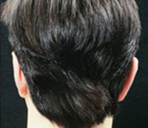 Real patient results before and after plastic surgery results in Glenview, IL, performed by Dr. Casas