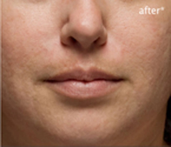 Real patient results before and after plastic surgery results in Glenview, IL, performed by Dr. Casas