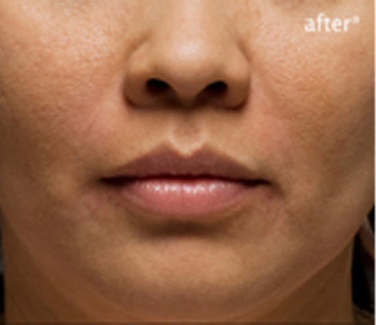 Real patient results before and after plastic surgery results in Glenview, IL, performed by Dr. Casas