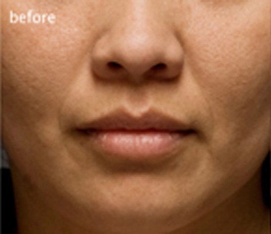 Real patient results before and after plastic surgery results in Glenview, IL, performed by Dr. Casas