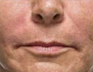 Real patient results before and after plastic surgery results in Glenview, IL, performed by Dr. Casas