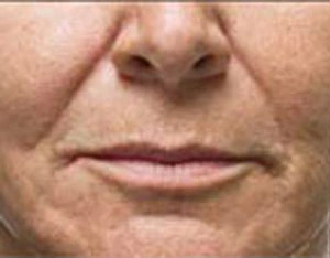 Real patient results before and after plastic surgery results in Glenview, IL, performed by Dr. Casas