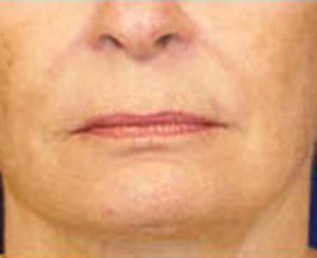 Real patient results before and after plastic surgery results in Glenview, IL, performed by Dr. Casas