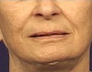 Real patient results before and after plastic surgery results in Glenview, IL, performed by Dr. Casas