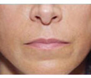 Real patient results before and after plastic surgery results in Glenview, IL, performed by Dr. Casas