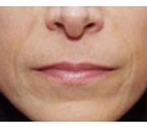 Real patient results before and after plastic surgery results in Glenview, IL, performed by Dr. Casas
