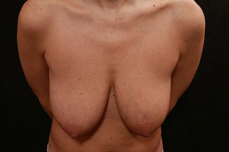 Real patient results before and after plastic surgery results in Glenview, IL, performed by Dr. Casas