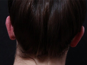 Real patient results before and after plastic surgery results in Glenview, IL, performed by Dr. Casas