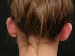 Real patient results before and after plastic surgery results in Glenview, IL, performed by Dr. Casas