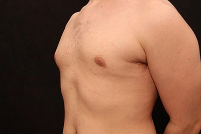 Real patient results before and after plastic surgery results in Glenview, IL, performed by Dr. Casas