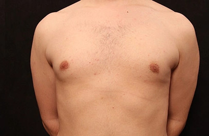 Real patient results before and after plastic surgery results in Glenview, IL, performed by Dr. Casas