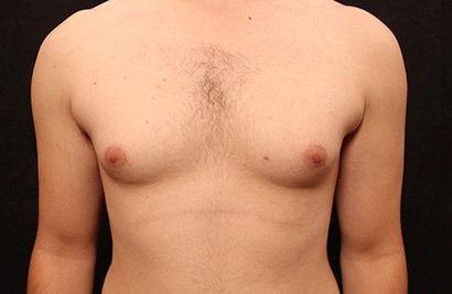 Real patient results before and after plastic surgery results in Glenview, IL, performed by Dr. Casas
