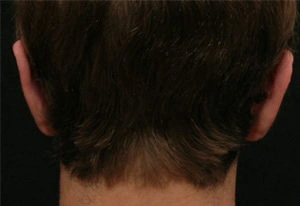 Real patient results before and after plastic surgery results in Glenview, IL, performed by Dr. Casas