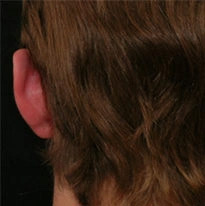Real patient results before and after plastic surgery results in Glenview, IL, performed by Dr. Casas